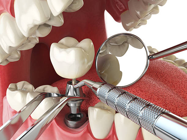 Best Emergency Root Canal Treatment in East Chicago, IN
